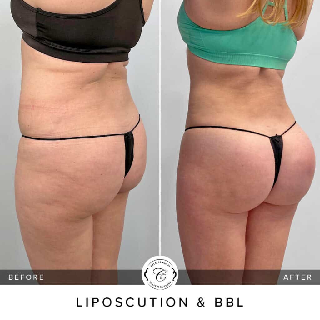 découvrez la définition du terme bbl, son origine et son utilisation dans divers contextes. informez-vous sur cette abréviation et son impact dans le langage moderne.